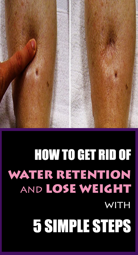 Main symptoms of water retention: